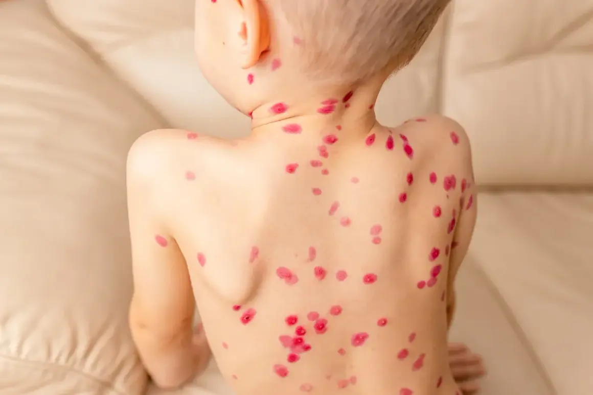 Niño con erupciones rojas en la espalda, mostrando las etapas de la varicela.