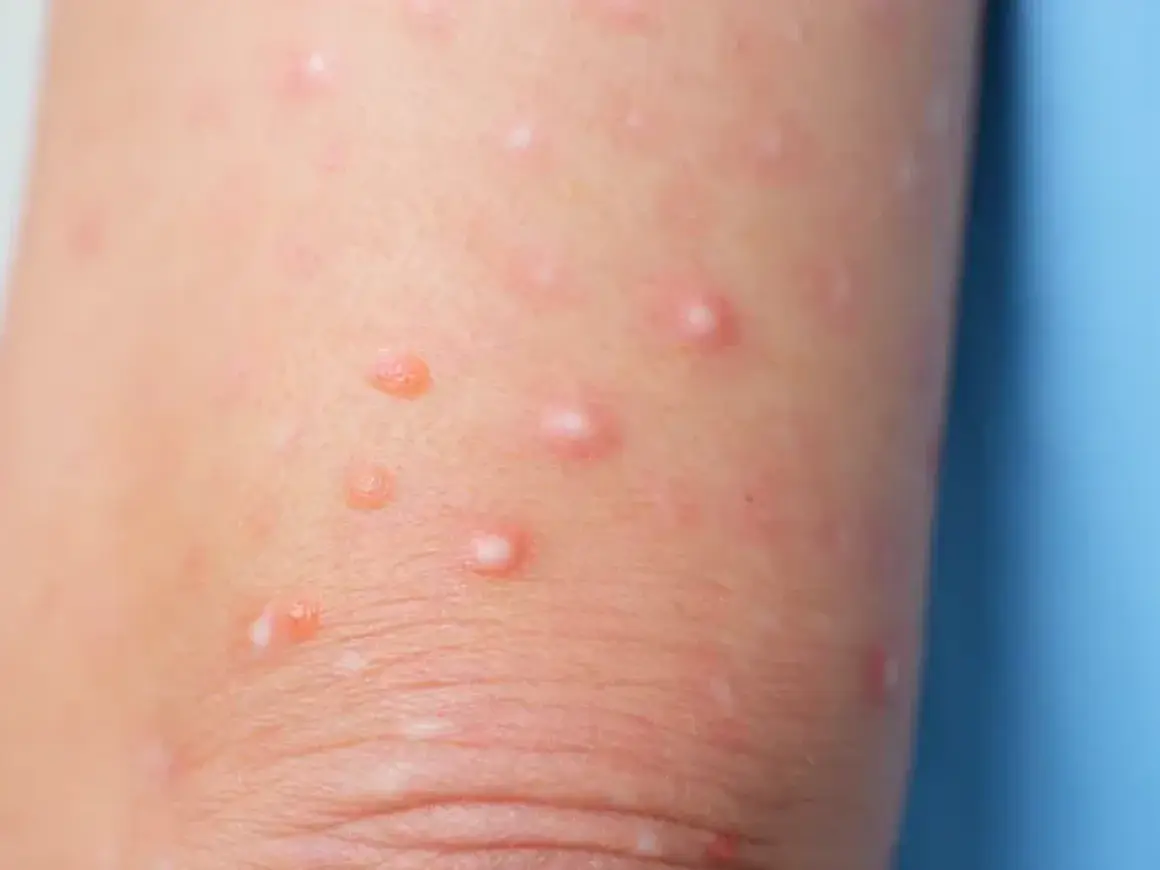 Piel de un niño con moluscos contagiosos, pequeñas protuberancias rosadas y blanquecinas que aparecen en la piel.