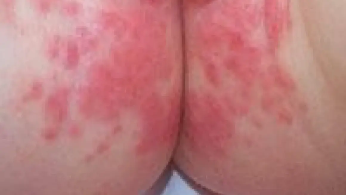 Piel irritada con enrojecimiento y pequeñas protuberancias, indicativo de dermatitis del pañal.