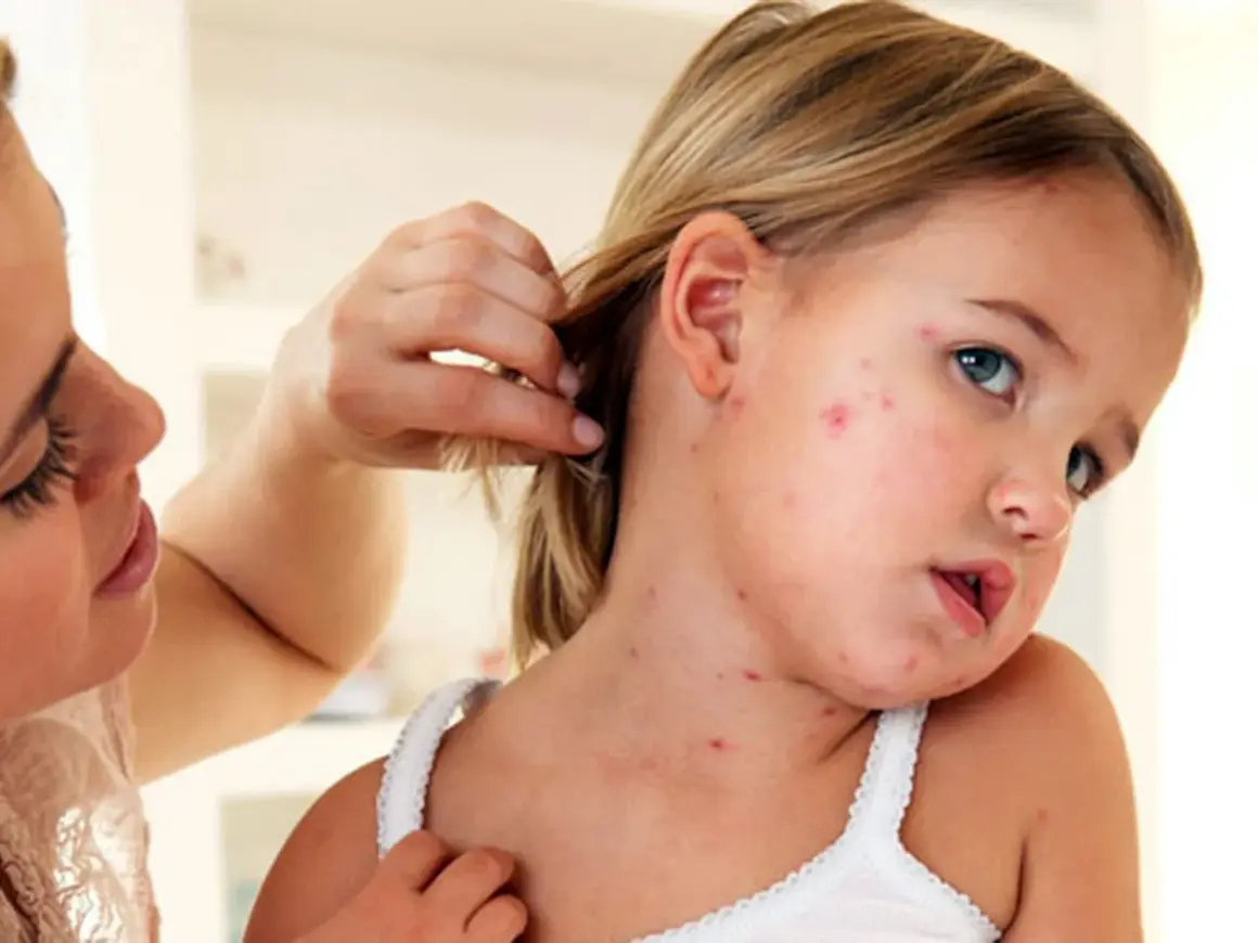 Niña con sarpullido por fiebre en la cara y cuello. Una mujer le aparta el pelo.