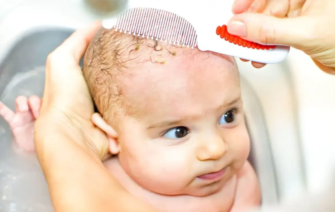 Bebé con dermatitis seborreica en la cabeza, siendo peinado suavemente con un peine especial para eliminar costras.