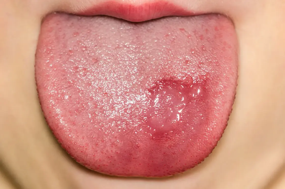 Lengua de niño con lesión rojiza y ampollas, indicativa de candidiasis oral.