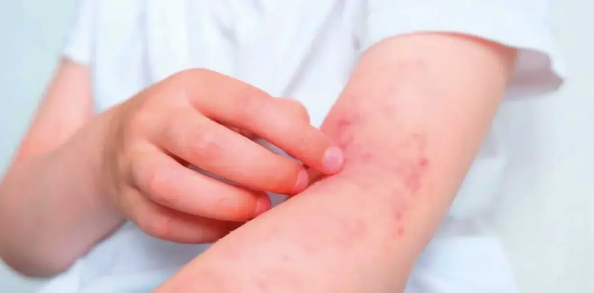 Brazo de niño con erupción roja y picazón, síntoma de dermatitis de contacto.