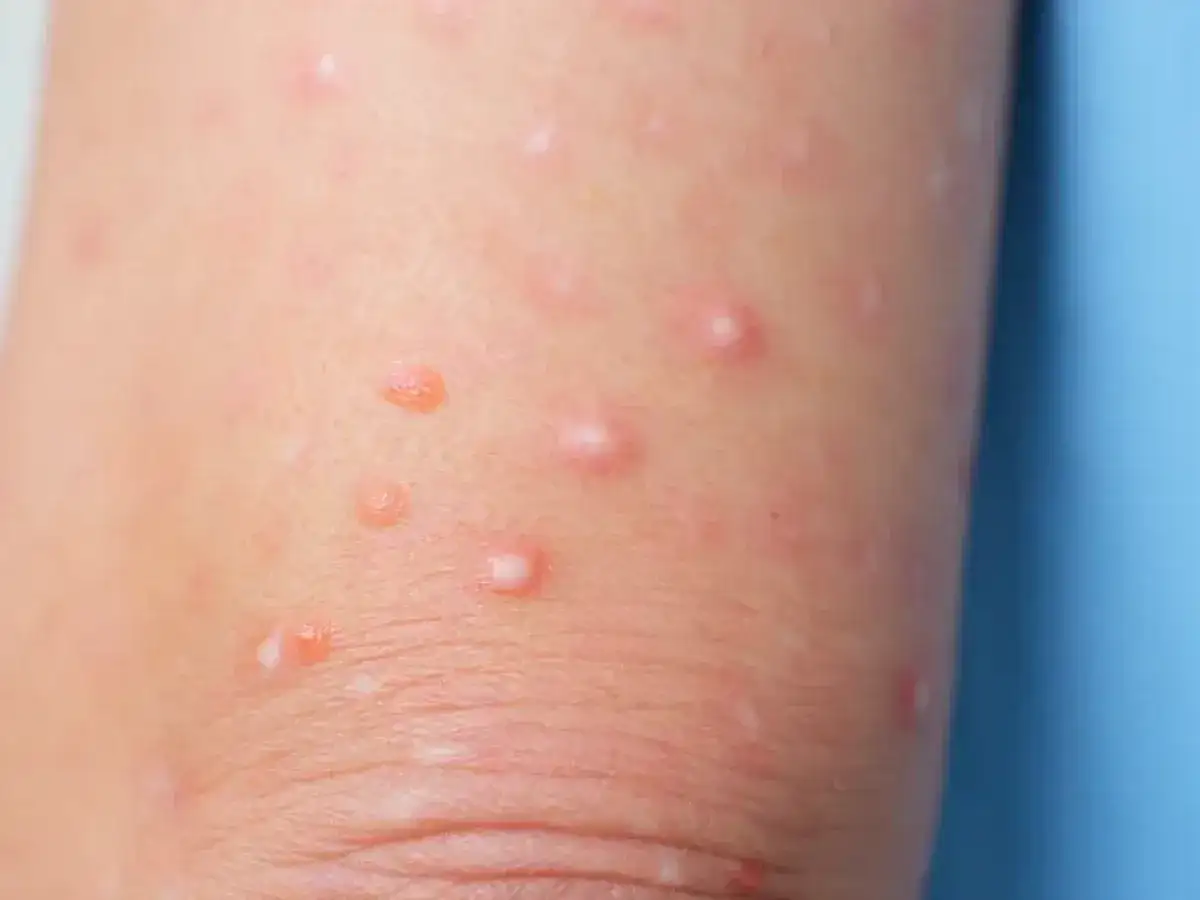 Molusco contagioso en niños, ¿cómo reconocerlo y cuándo tratarlo?