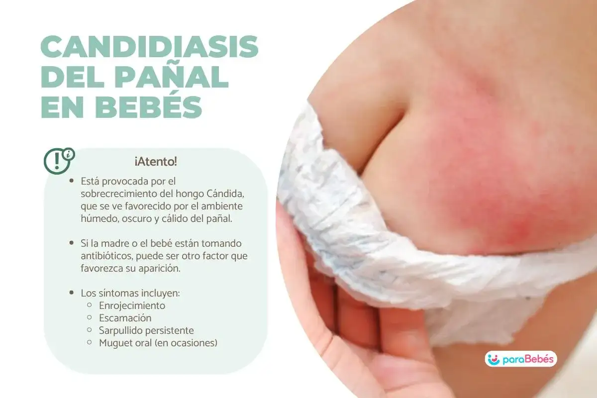 Candidiasis del pañal - señales, cuidados y cuándo ir al pediatra