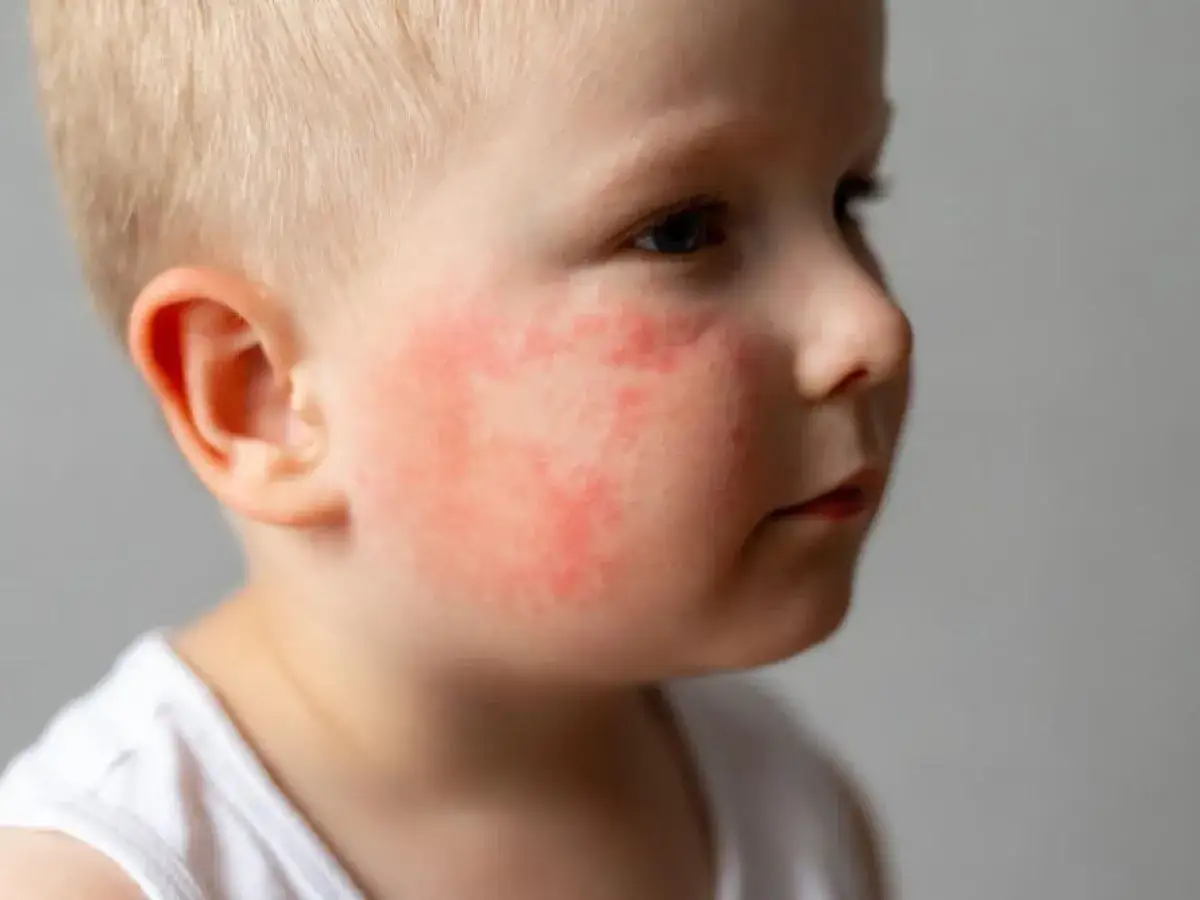 Niño con mejillas rojas y erupción cutánea, posible signo de impétigo en niños.