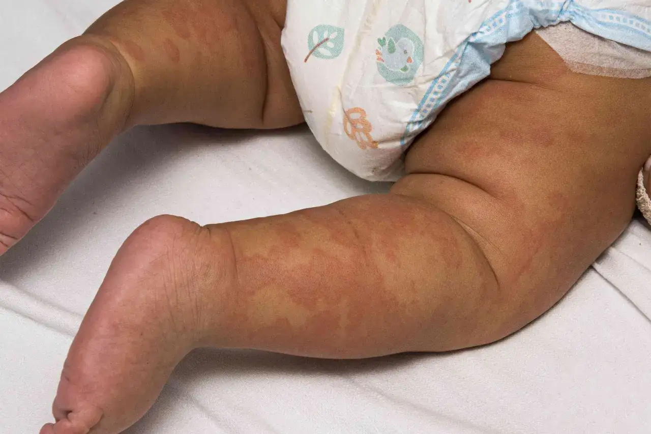Beb&eacute; con sarpullido en las piernas, posiblemente por una alergia alimentaria. La piel presenta manchas rojas y elevadas.