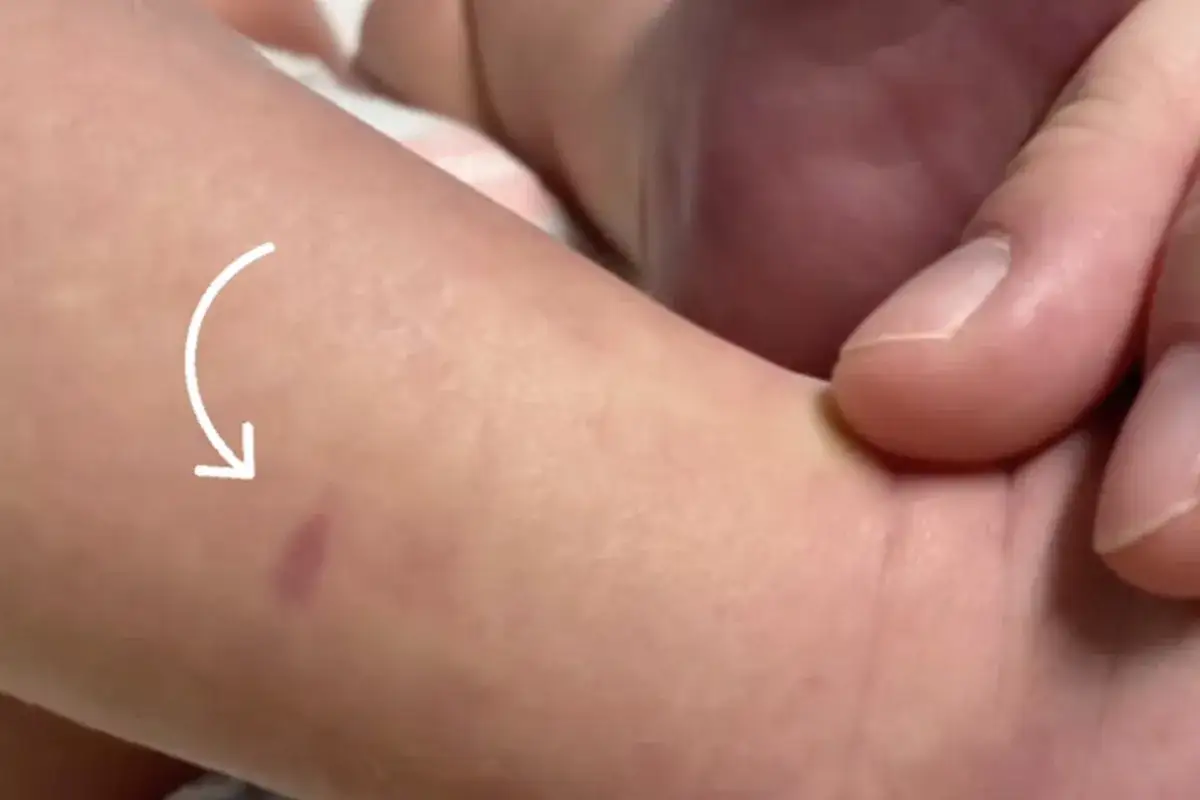 Piel de beb&eacute; con un peque&ntilde;o sarpullido morado, posible signo de meningitis.