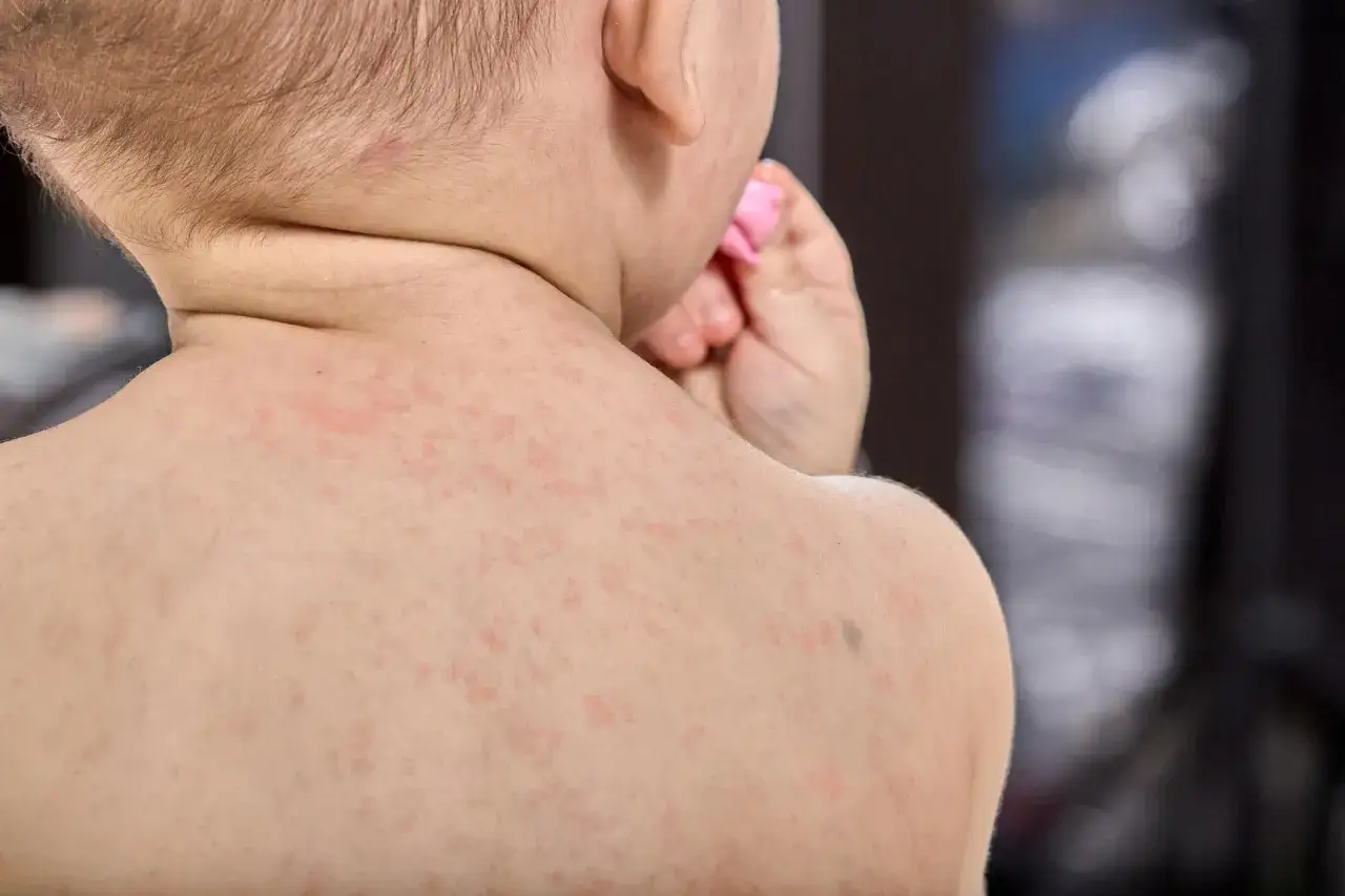 Piel de un ni&ntilde;o con sarpullido por fiebre, peque&ntilde;as manchas rojas cubren su espalda y cuello.