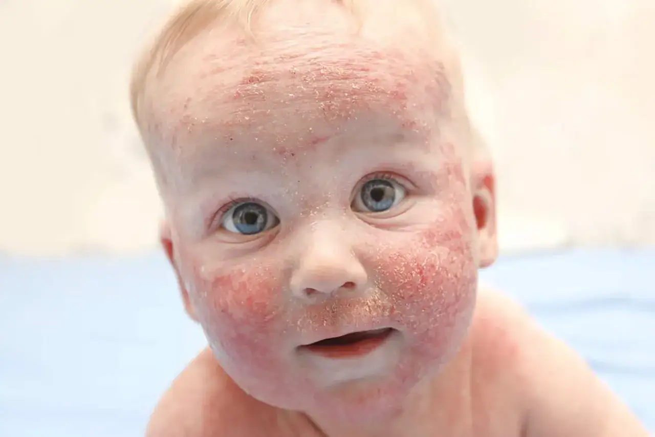 Beb&eacute; con piel enrojecida y escamosa, s&iacute;ntomas de dermatitis at&oacute;pica.