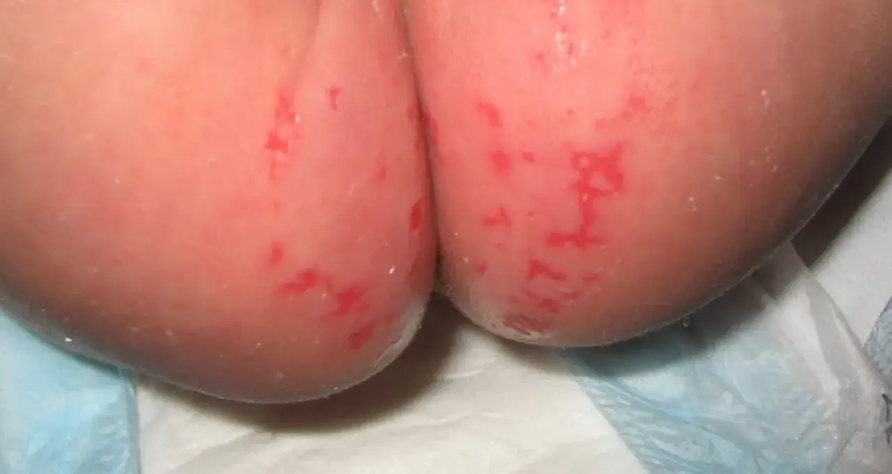 Beb&eacute; con erupci&oacute;n roja y escamosa en la zona del pa&ntilde;al, indicativa de candidiasis del pa&ntilde;al.