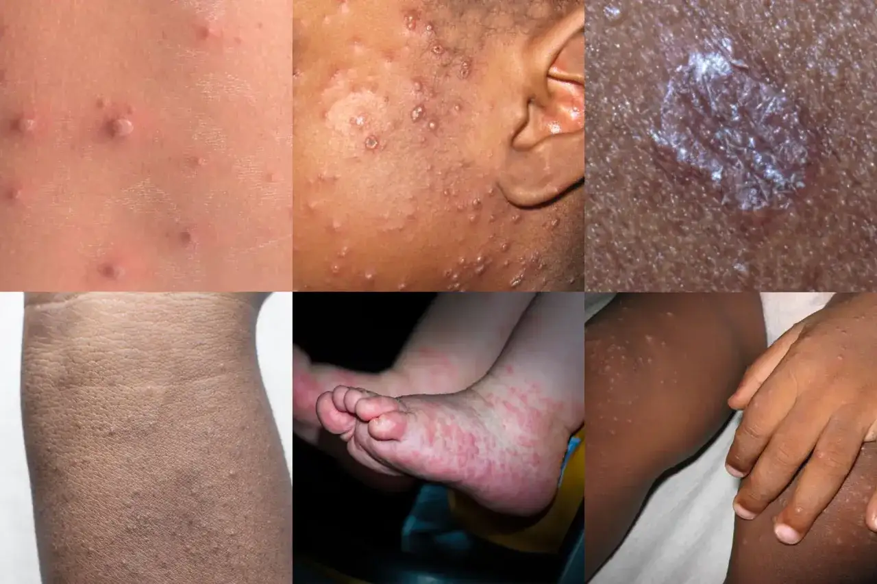 Primer plano de sarpullidos en la piel, incluyendo ampollas y parches rojos, en diferentes partes del cuerpo.