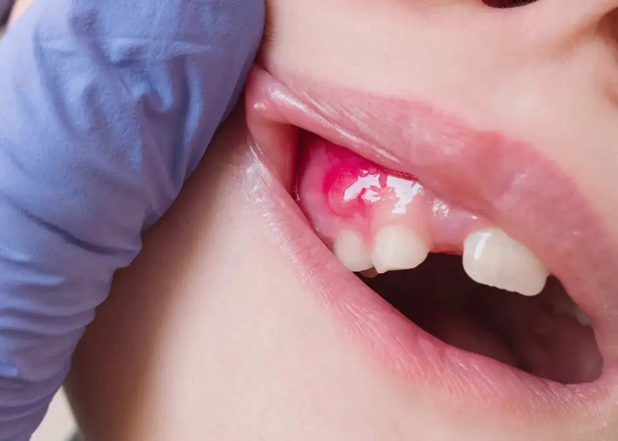 Enc&iacute;a inflamada en beb&eacute;, posible salida de dientes beb&eacute; 4 meses. Diente asomando.