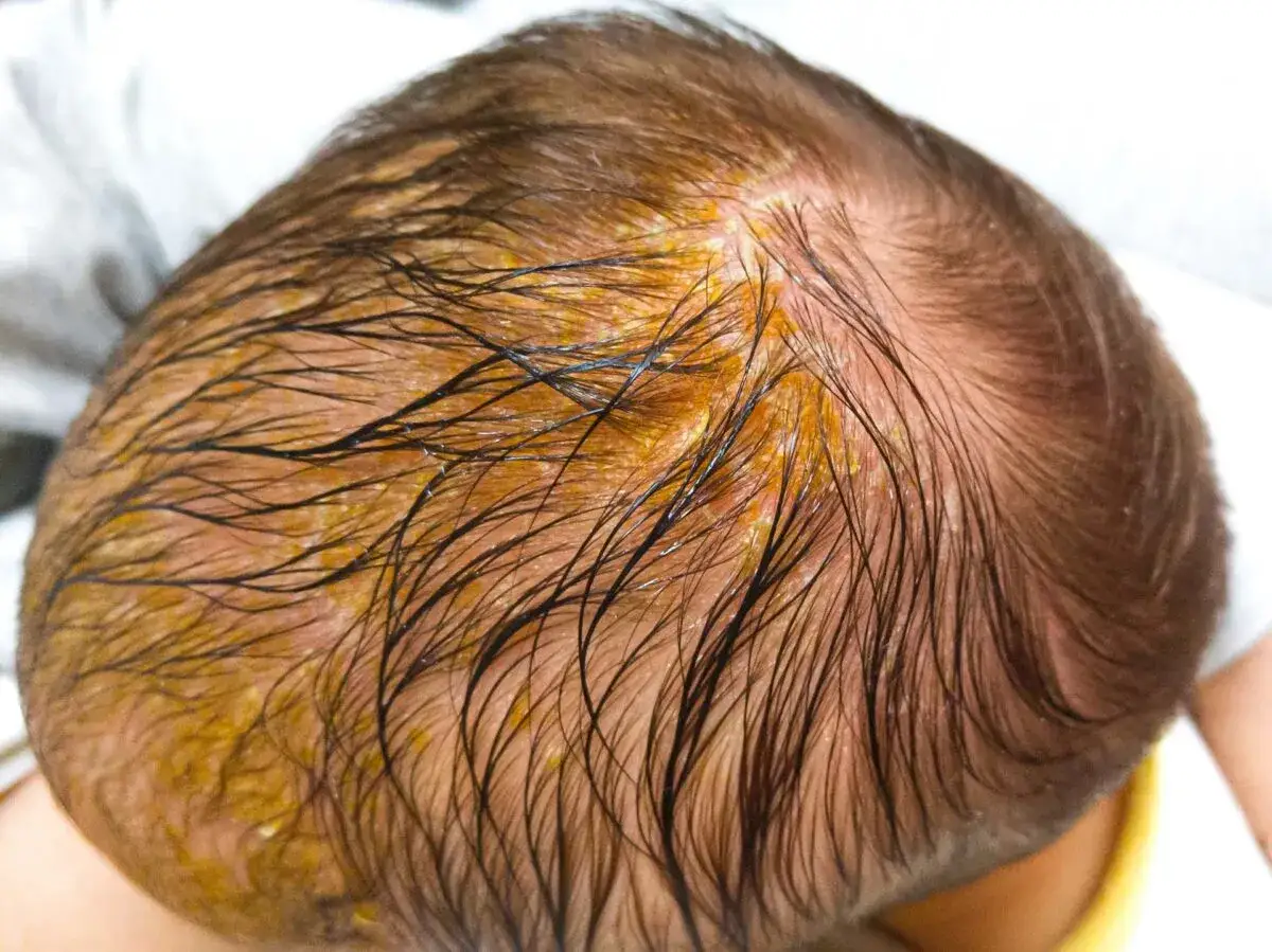 Cabeza de bebé con costras amarillentas y cabello oscuro, indicativo de dermatitis seborreica infantil.
