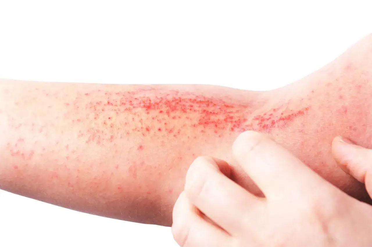 Brazo con erupci&oacute;n roja y picaz&oacute;n, indicando una posible alergia a la ropa.