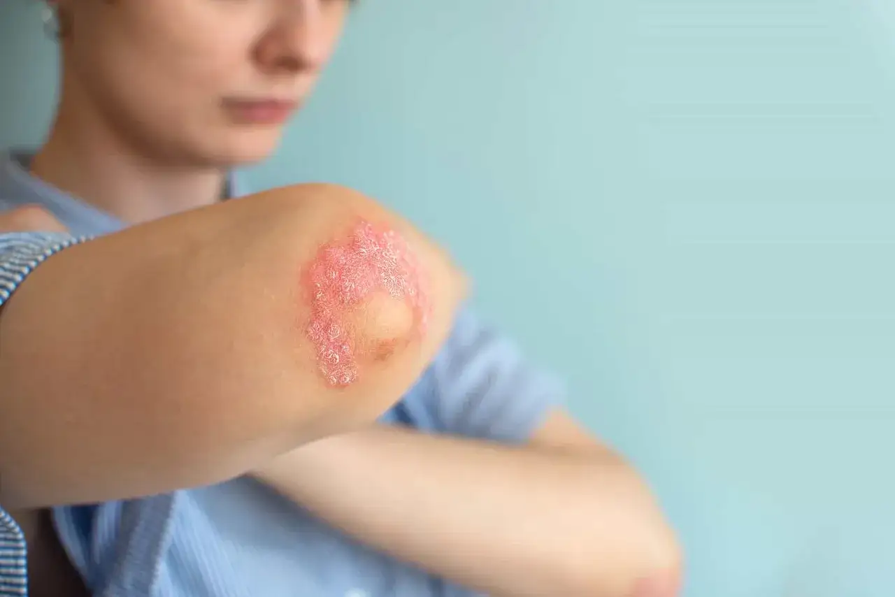 Codo con placas rojas y escamosas, indicativo de psoriasis en niños.