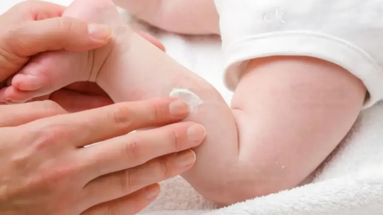 Manos aplican crema en la pierna de un beb&eacute; con sudamina.