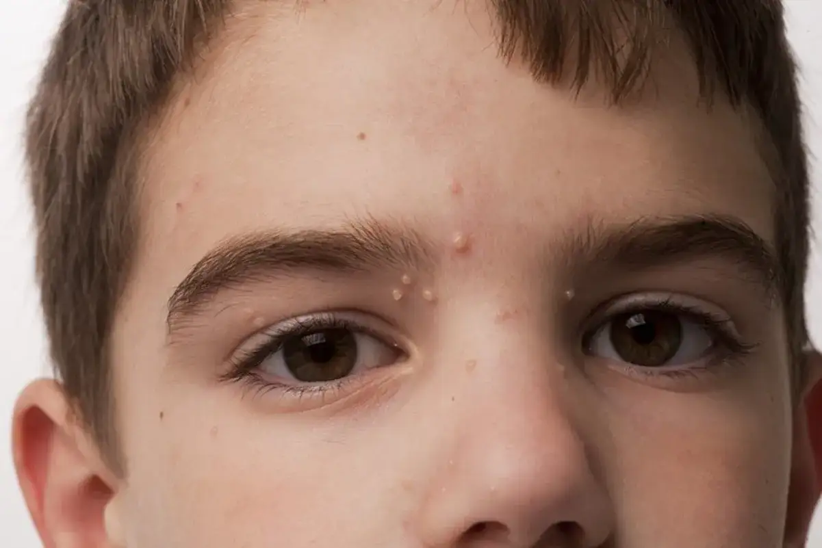 Primer plano de la cara de un ni&ntilde;o con moluscos contagiosos en la frente y alrededor de los ojos.