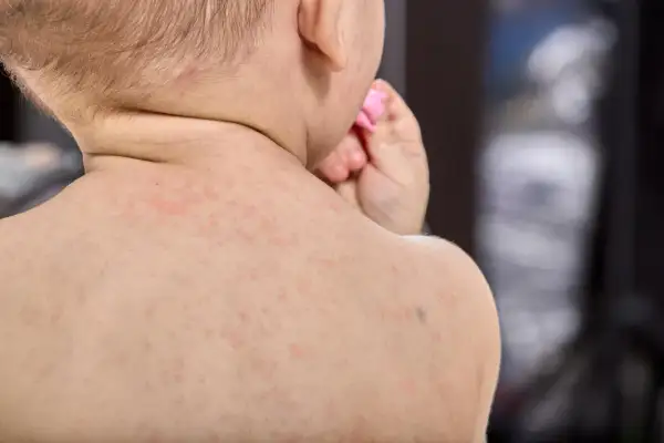 Bebé con sarpullido en la espalda, posible síntoma de meningitis.