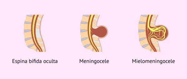 Ilustración de espina bífida en bebés: oculta, meningocele y mielomeningocele.
