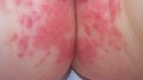 Piel irritada con enrojecimiento y pequeñas protuberancias, indicativo de dermatitis del pañal.