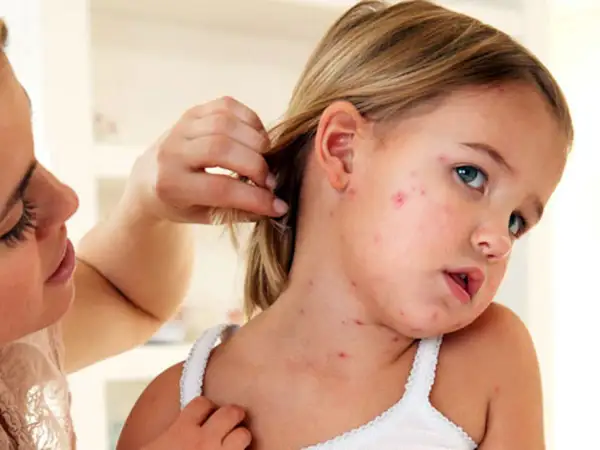 Niña con sarpullido por fiebre en la cara y cuello. Una mujer le aparta el pelo.