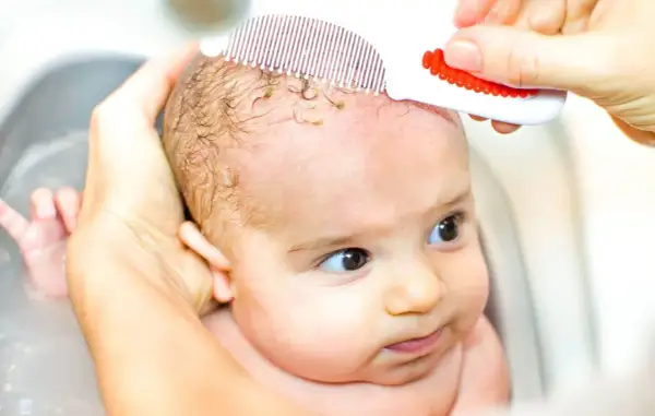 Bebé con dermatitis seborreica en la cabeza, siendo peinado suavemente con un peine especial para eliminar costras.