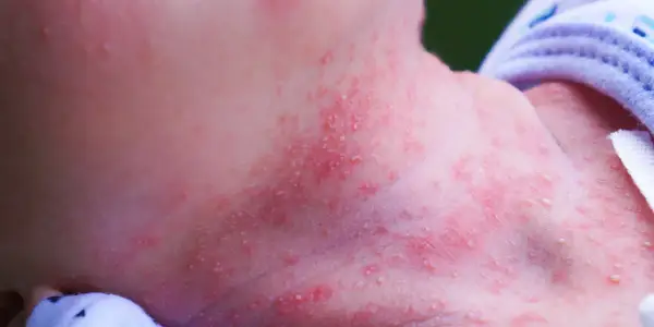 Piel enrojecida con pequeños bultos blancos y rojos en el cuello de un bebé, indicativo de sudamina.