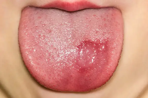 Lengua de niño con lesión rojiza y ampollas, indicativa de candidiasis oral.
