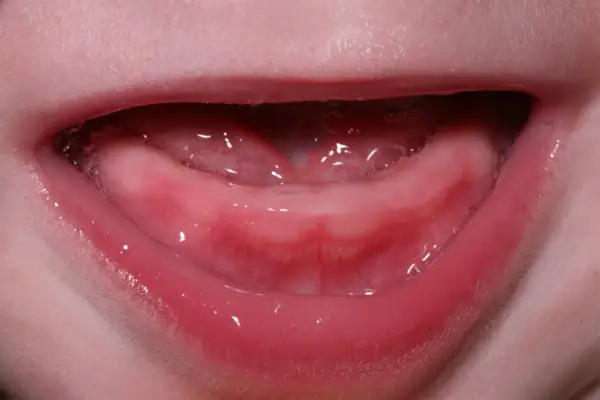 Encías rosadas y húmedas, con burbujas, listas para los primeros dientes bebé 4 meses.