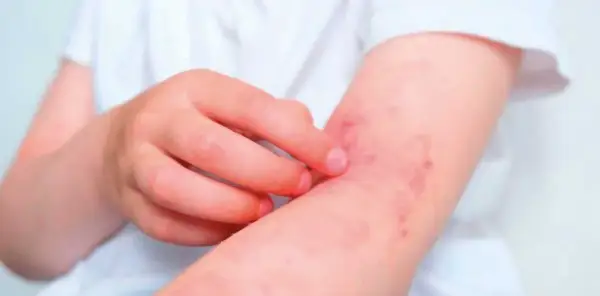 Brazo de niño con erupción roja y picazón, síntoma de dermatitis de contacto.