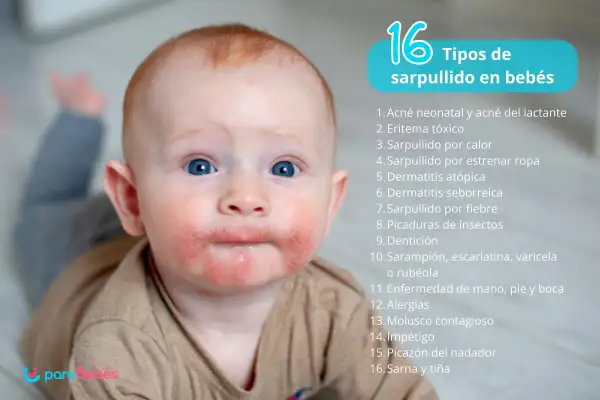 Bebé con sarpullidos en la piel alrededor de la boca y mejillas. La imagen lista 16 tipos de sarpullidos en bebés.